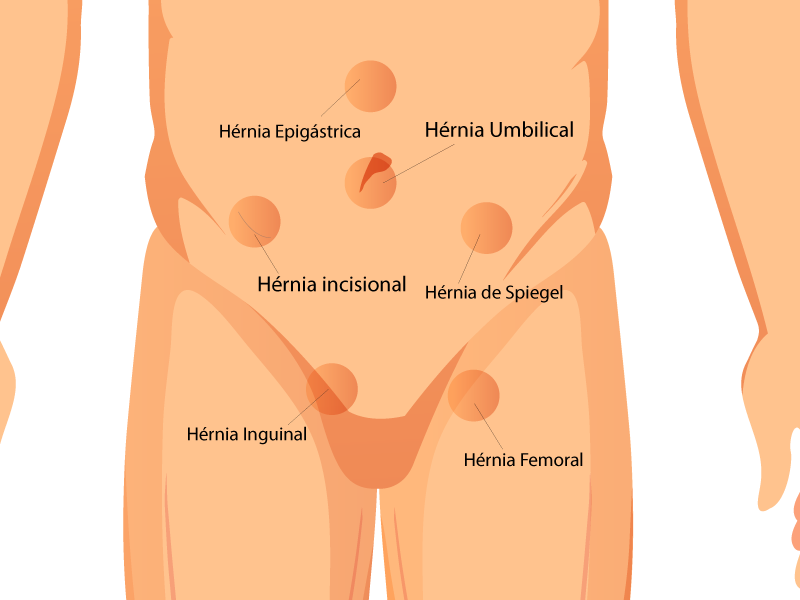 Tipos de hérnia e como reconhecer