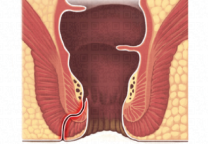 Abscesso e Fístula Perianal