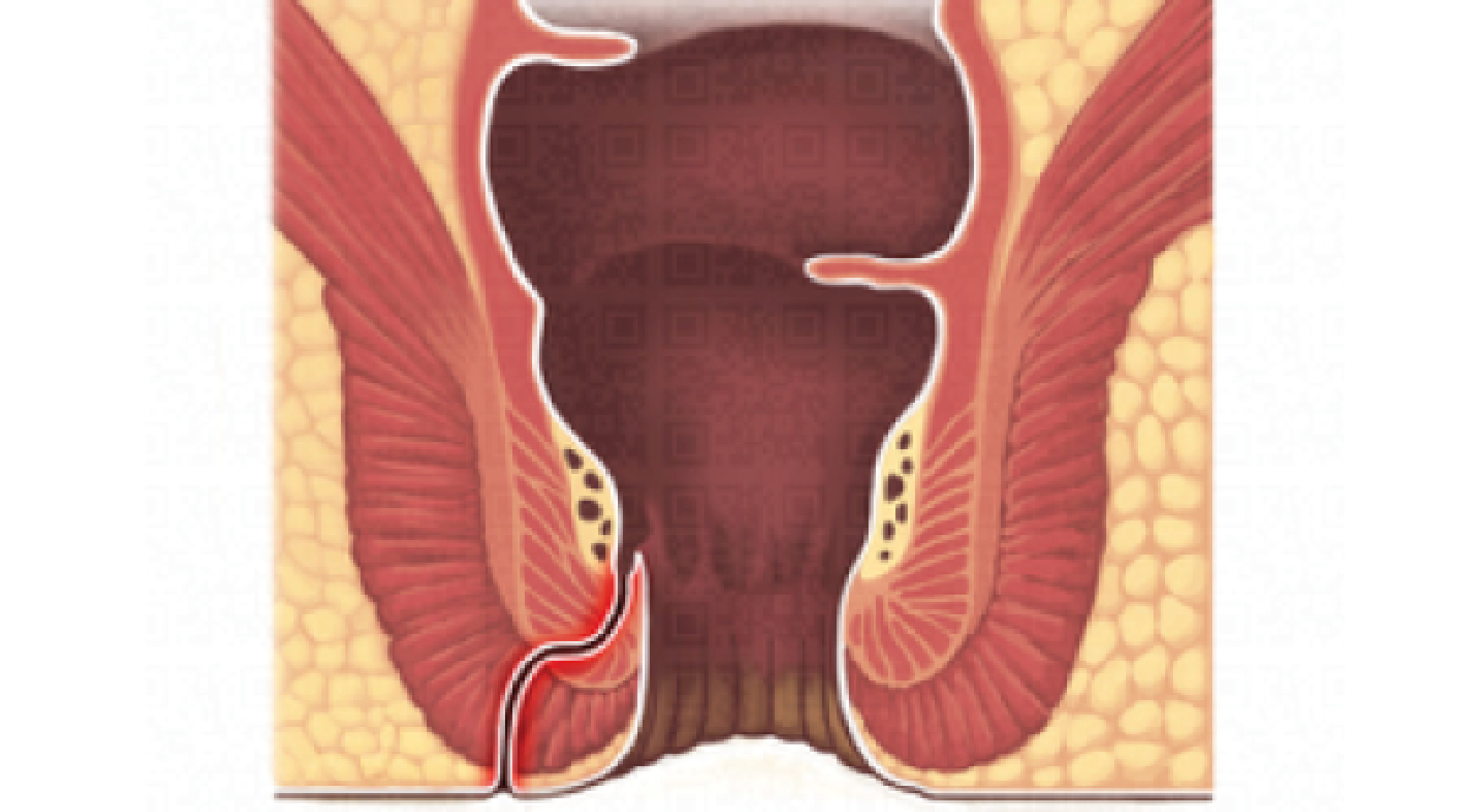 Fístula anal/perianal: o que é, sintomas, tratamento e cirurgia