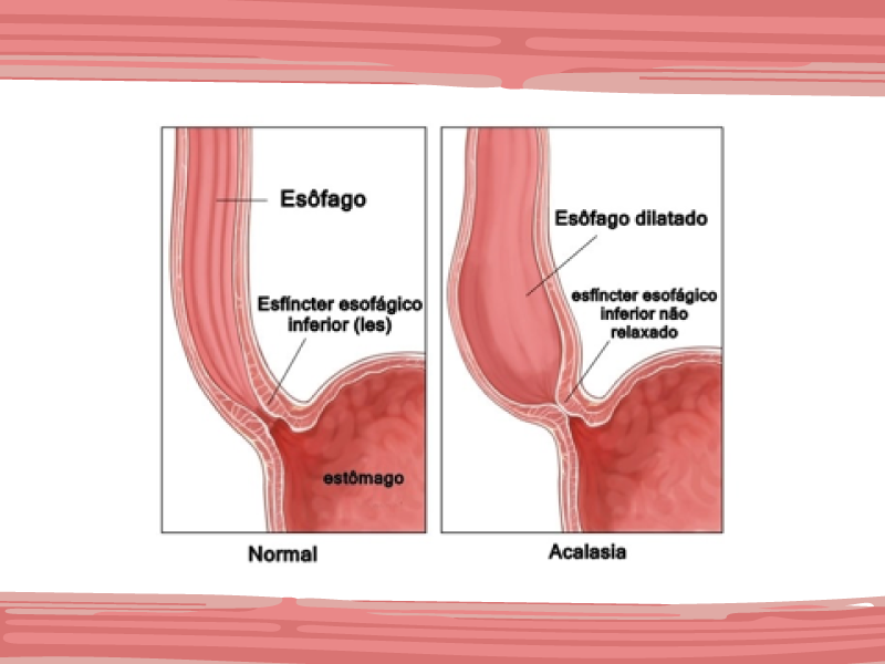 Resultados da dilatação endoscópica versus a cardiomiotomia em