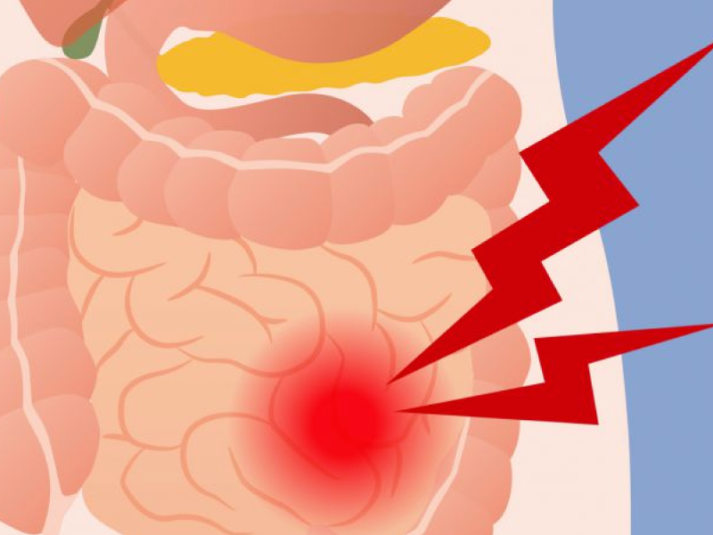 Síndrome do Intestino Irritável