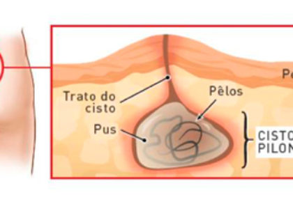 Cisto Pilonidal