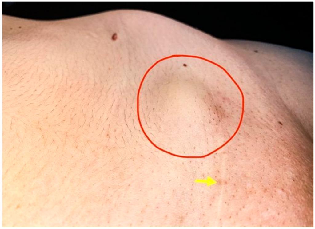 Correção da cicatriz resultante da cesárea isolada ou associada a outros  procedimentos