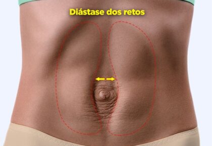 DIÁSTASE DE RETOS ABDOMINAIS